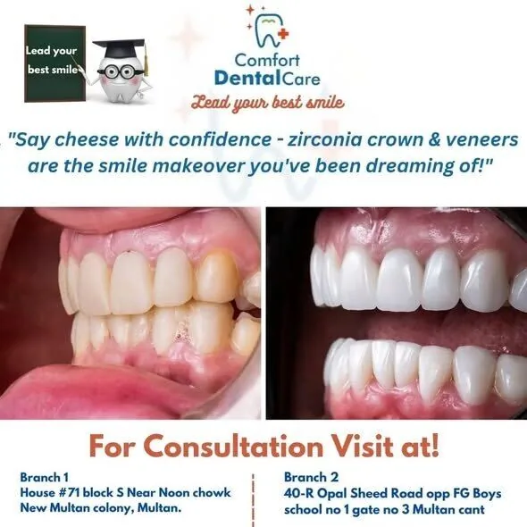 Before and after zirconia crown restoration on front teeth