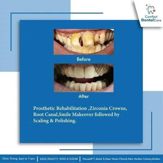 Before and after prosthetic rehabilitation with fiber post core buildup