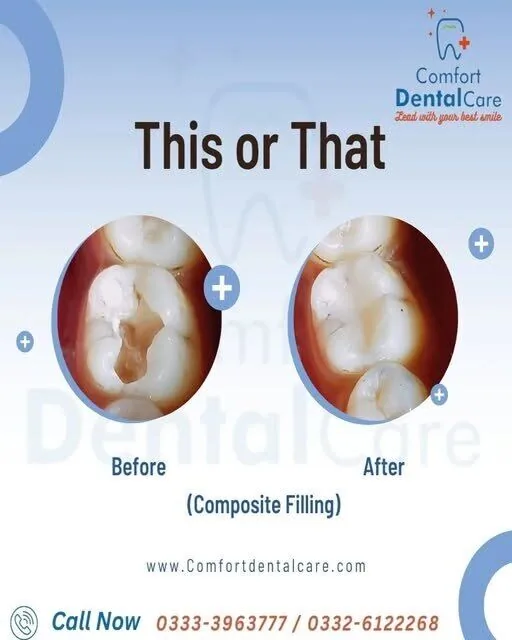 Before and after composite dental filling