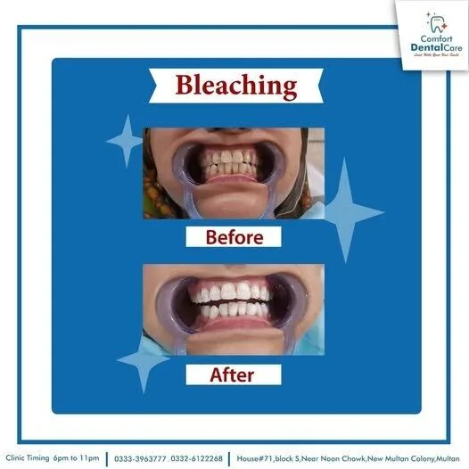Before and after professional in-clinic teeth whitening