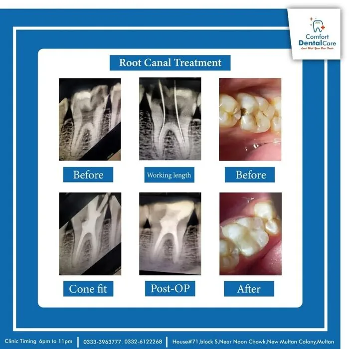 X-ray series documenting a root canal treatment from diagnosis to completion