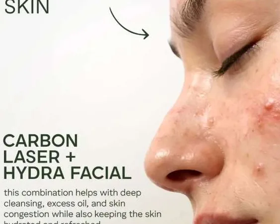 Acne-prone skin treatment