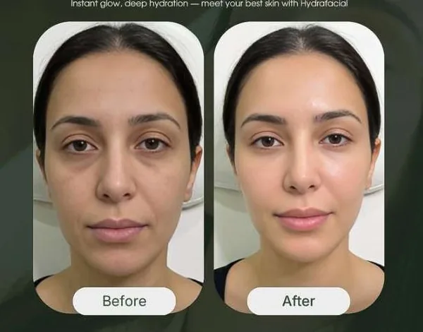 HydraFacial before and after result