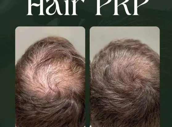 Hair PRP before and after result