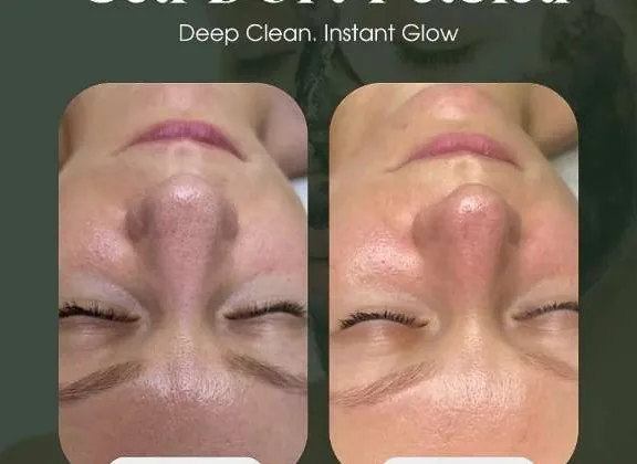 Carbon facial before and after result